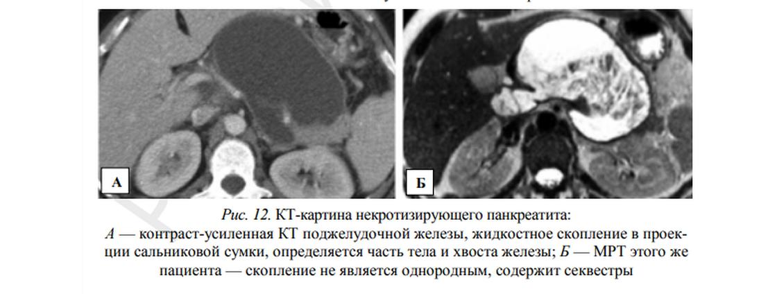 Кт картина панкреатита