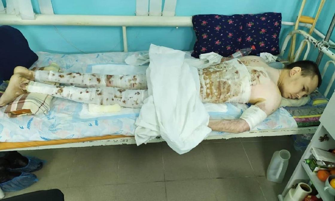Обгоревший герой 8 месяцев лежит в больнице и мучается от адской боли в Актобе