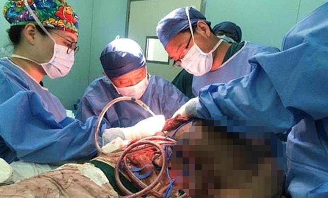 Китаец 30 лет жил с 15-килограммовой опухолью на спине (фото)