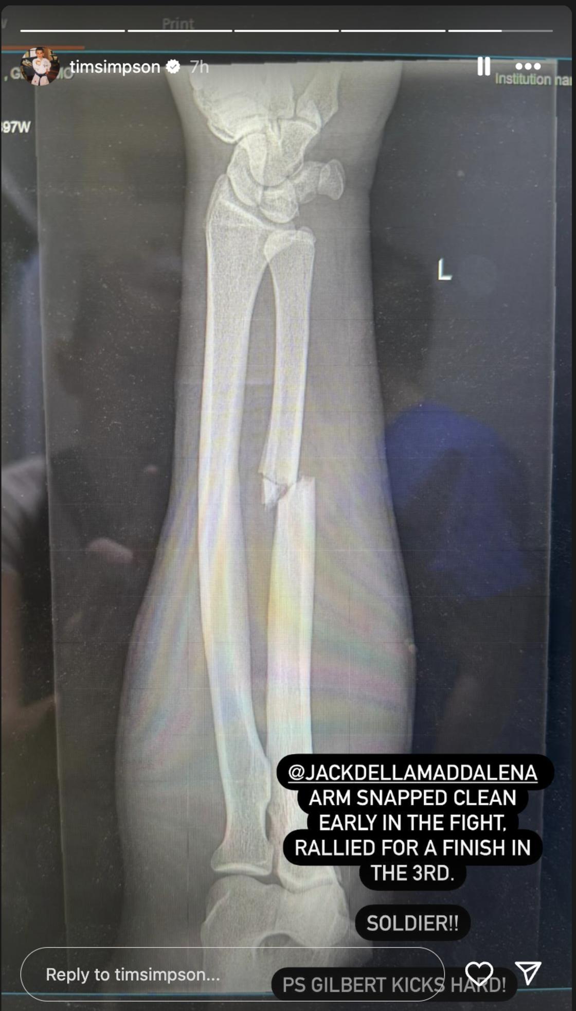 Джек Делла Маддаленаның сынған қолының рентген суреті