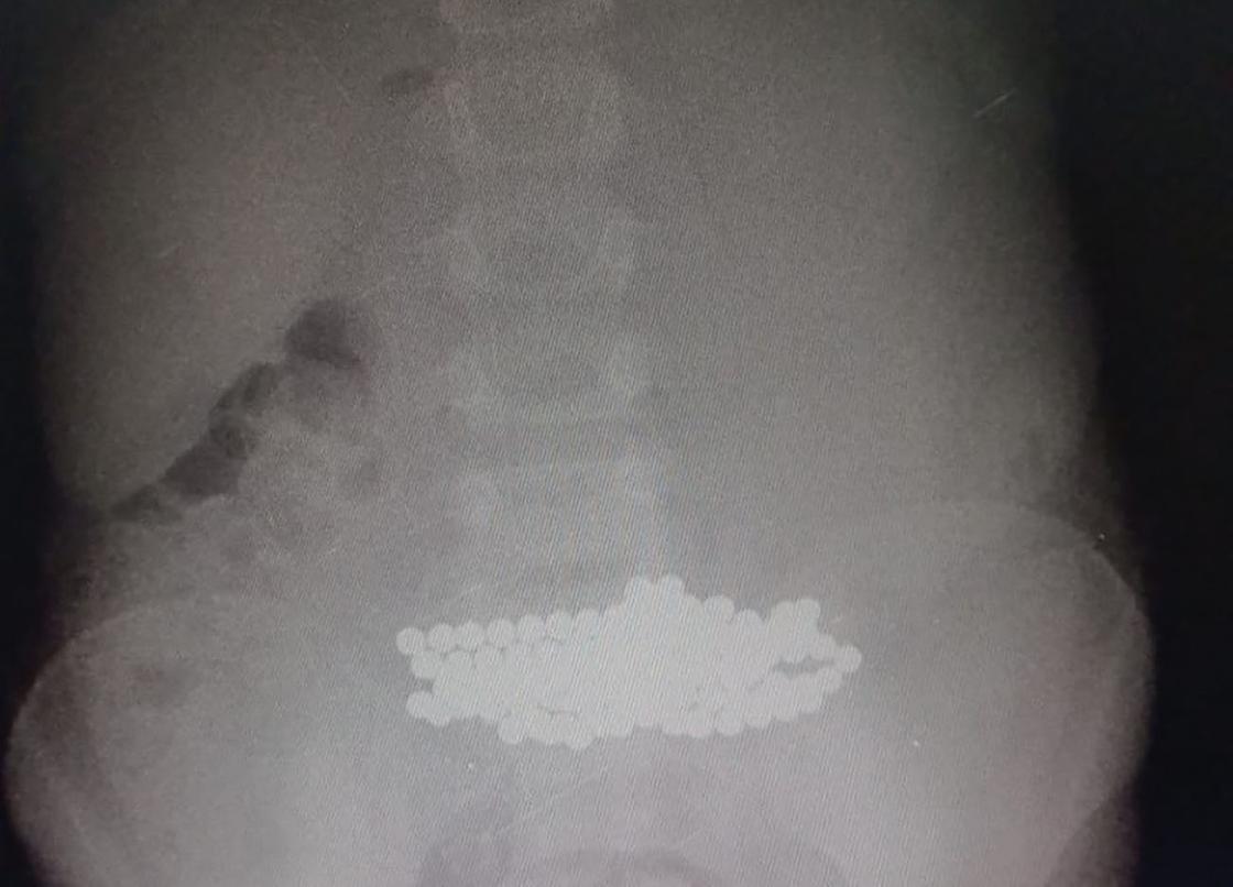 Рентгеновский снимок магнитов в желудке ребенка