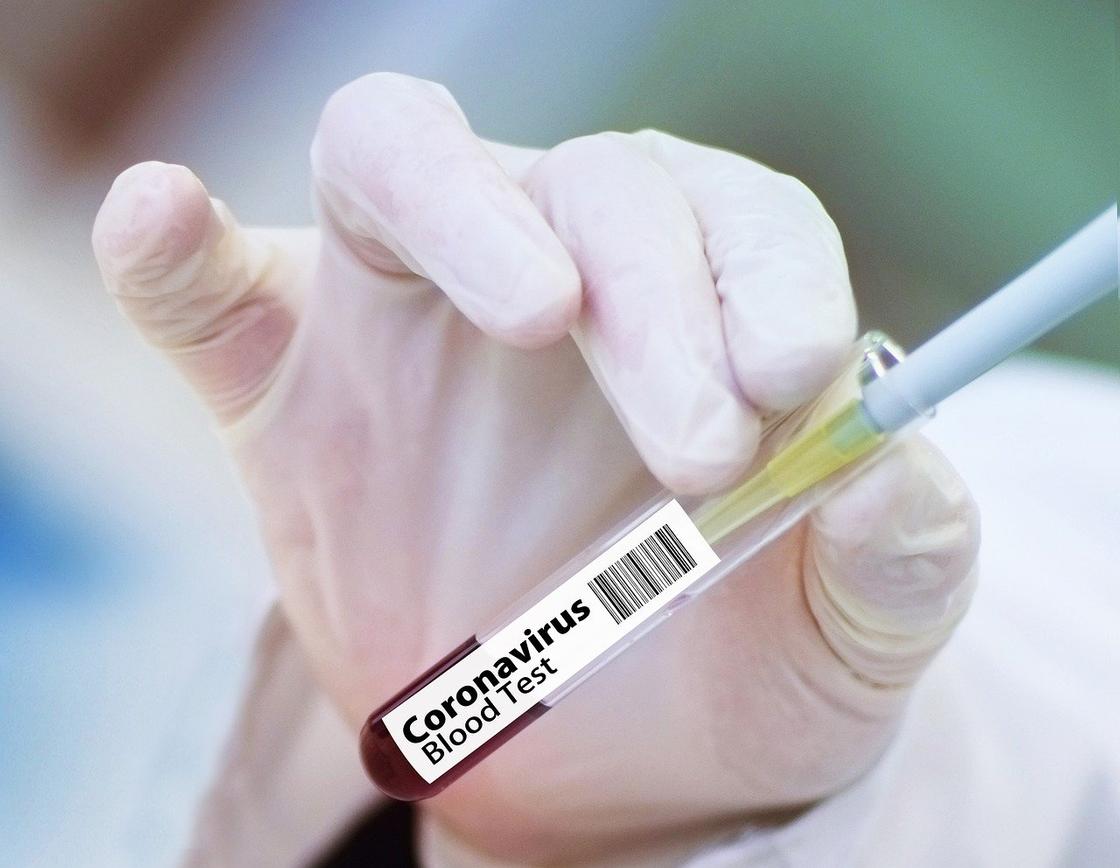 Ғалымдар коронавирус кезіндегі күшті иммундық реакция туралы айтты