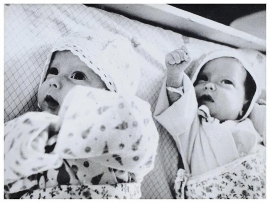 ФОТОРЕП Один живот на двоих: как живут удачно разделенные в СССР сиамские близнецы (фото)