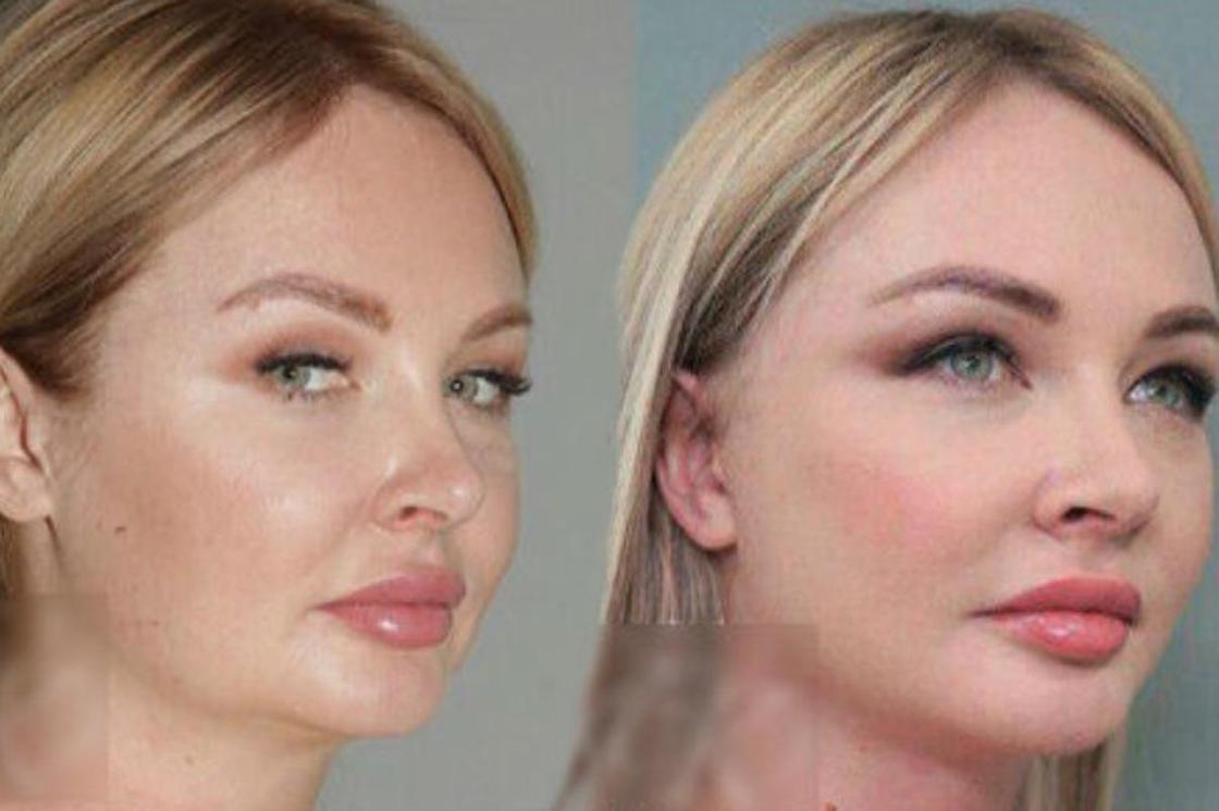 Пластический хирург показал фото звезды "Дома-2" Дарьи Пынзарь до и после операции