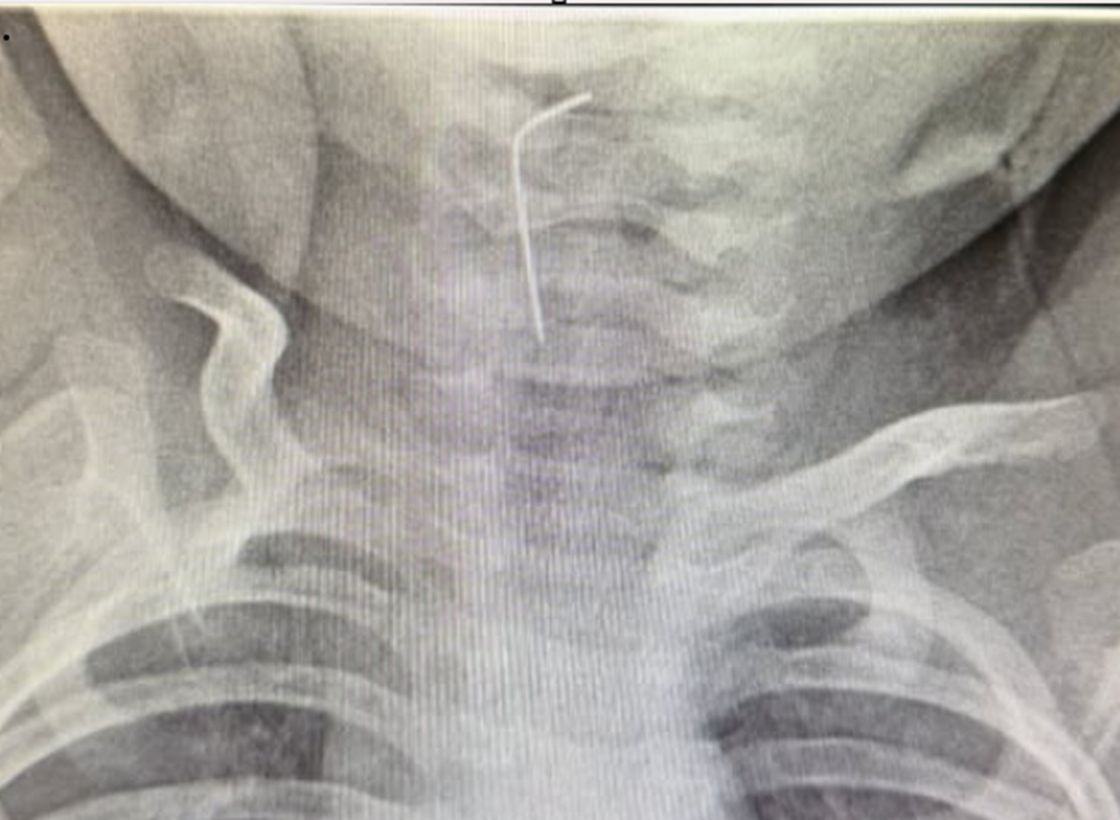 Алынған ине