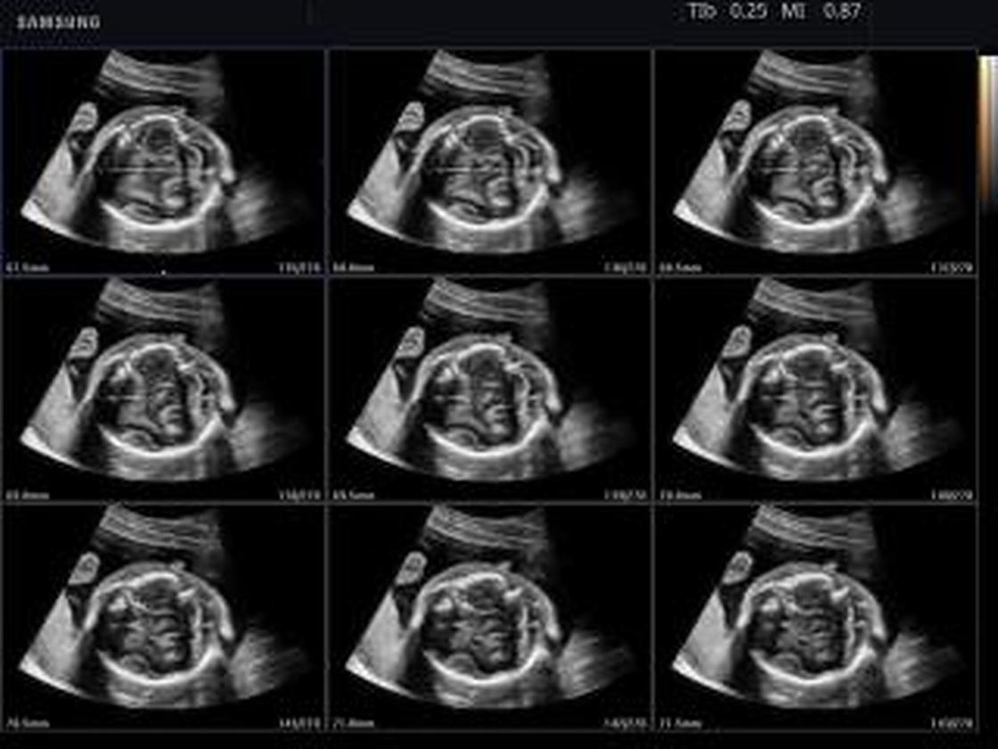 28 неделя беременности: что происходит с малышом и будущей мамой, анализы, фото, УЗИ