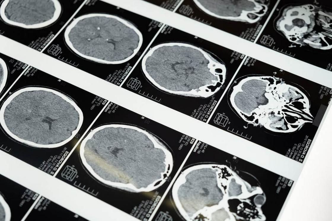 Снимки с МРТ головного мозга