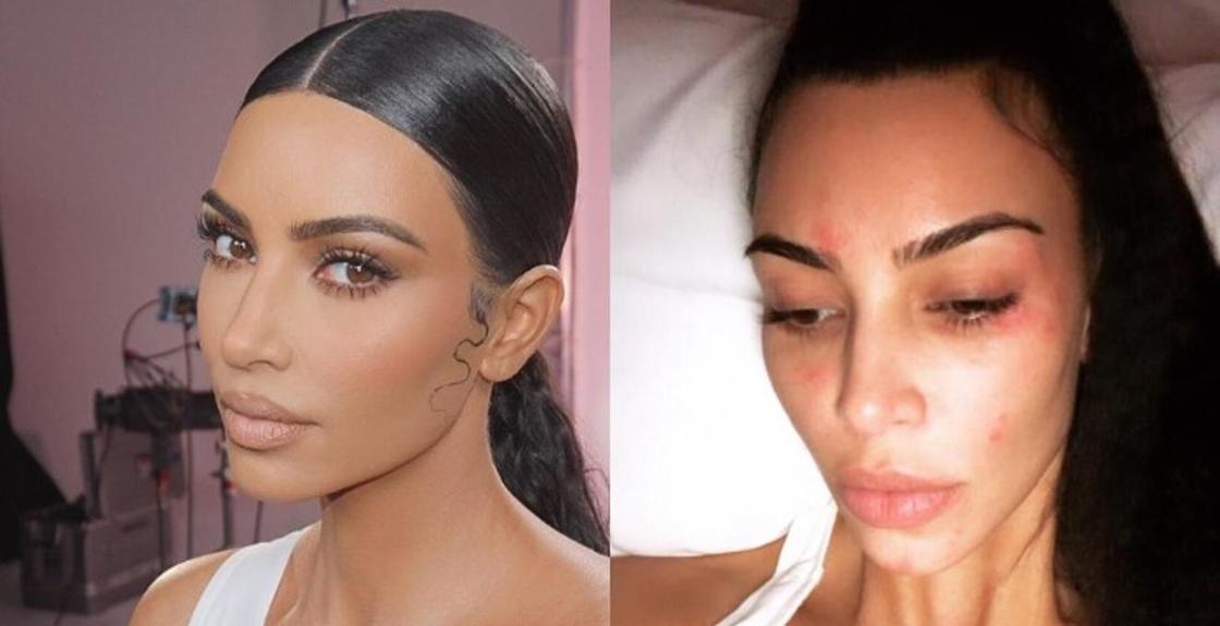 Ким Кардашьян показала прогрессирующее кожное заболевание на фото без макияжа