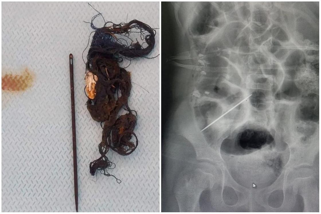 Иглу и клок волос вытащили врачи из 14-летнего подростка-инвалида в Актау