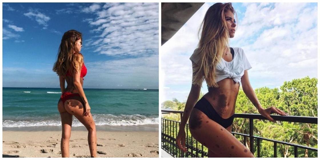 ФОТОРЕПОРТАЖДевушка с родимыми пятнами по всему телу вызывает ужас у людей, но считает себя сексуальной (фото) ФОТОРЕПОРТАЖДевушка с родимыми пятнами по всему телу вызывает ужас у людей, но считает себя сексуальной (фото)