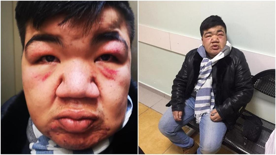 Стало известно о состоянии жестоко избитого клоуна Крохи в Алматы