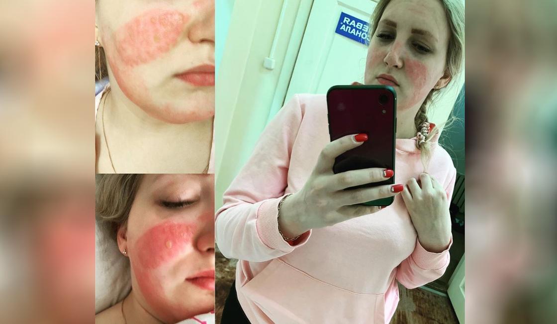 Медсестра получила химические ожоги лица из-за медицинской маски (фото, 18+) Медсестра получила химические ожоги лица из-за медицинской маски (фото, 18+)