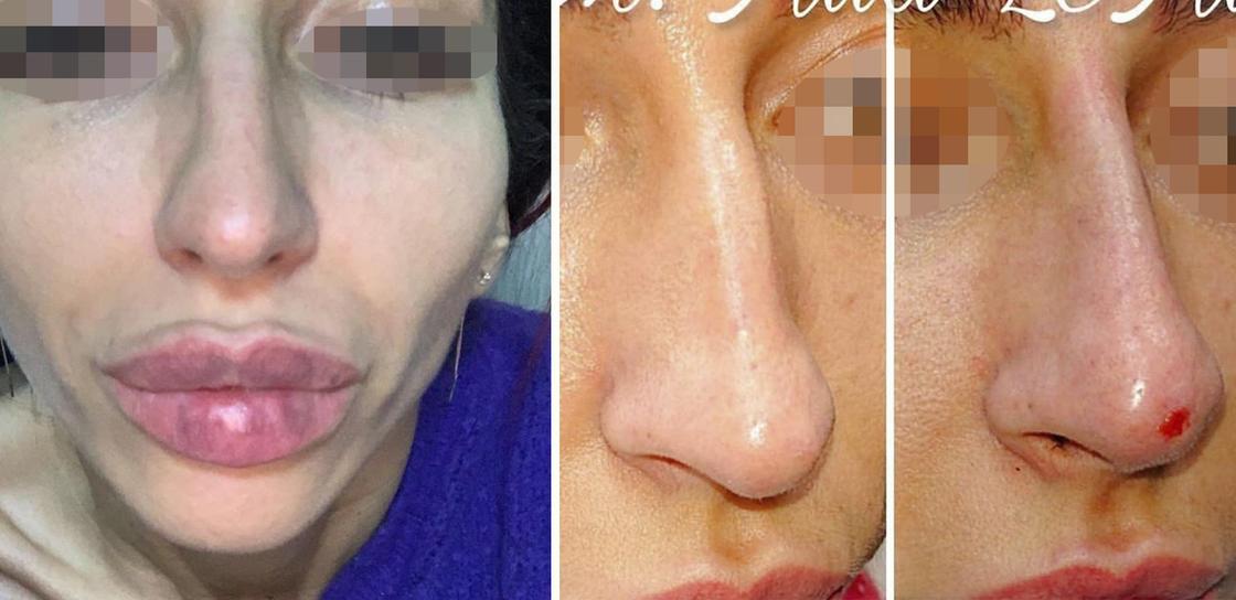 Шрамы, кривой нос и губы за 500 тысяч: астанчанка заявила, что косметолог испортил ей лицо