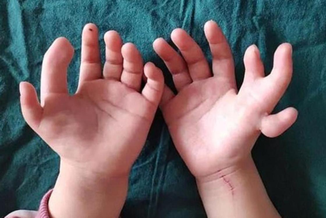 Девочке с 14 пальцами отрезали лишние Девочке с 14 пальцами отрезали лишние