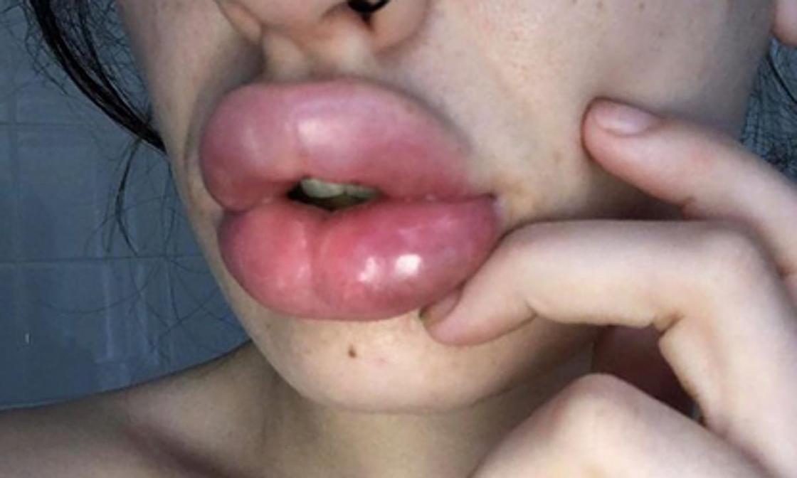 Женщина сэкономила на косметологе и получила распухшие и выцветшие губы