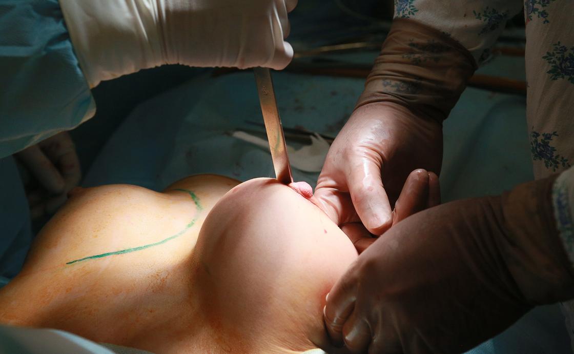 Как делаются операции по увеличению груди в Казахстане (фото 18+)