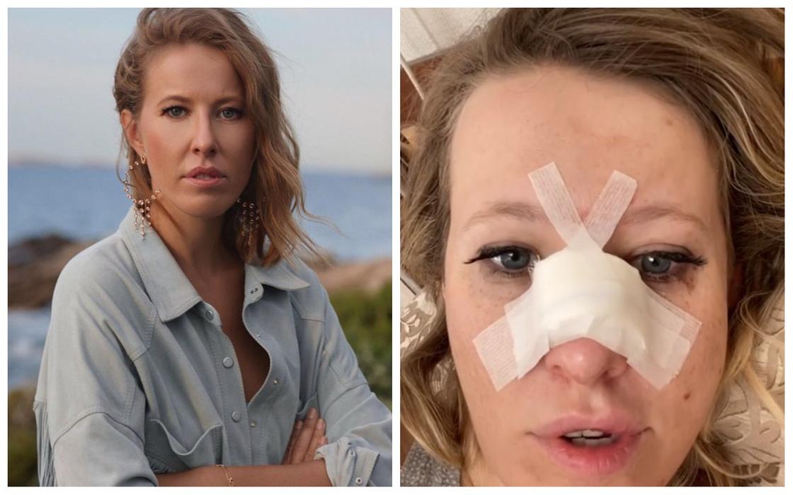 Ксении Собчак срочно провели операцию после перелома носа (видео)