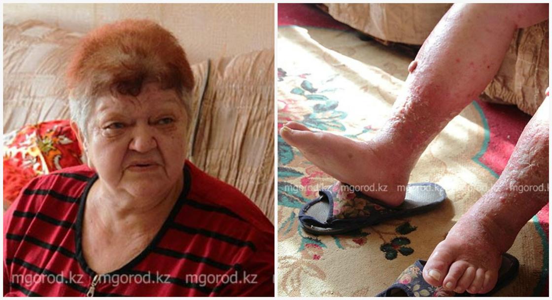 "Хочу наложить на себя руки": невыносимую боль испытывает из-за язв жительница Уральска