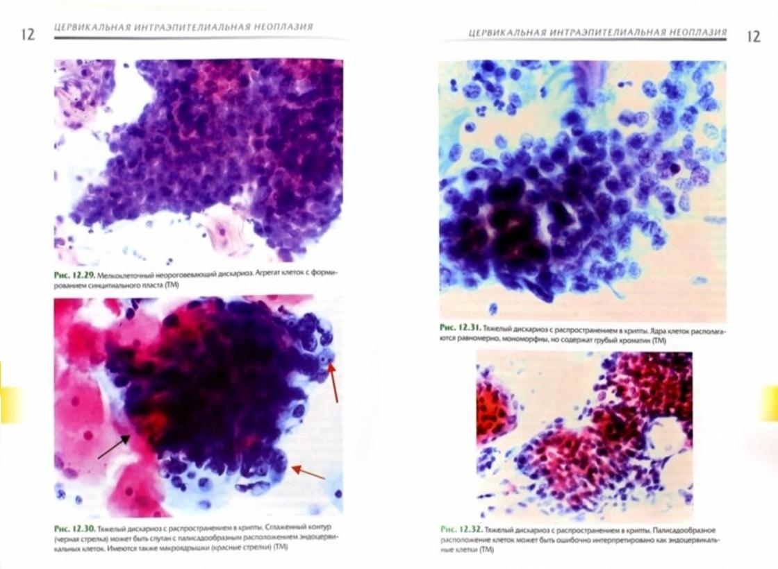 Выделение фиолетового цвета. Цитологический атлас заболеваний шейки матки Шабалова. Дисплазия эпителия шейки матки цитология. Паракератоз что это в цитологии. Атлас цитологии.