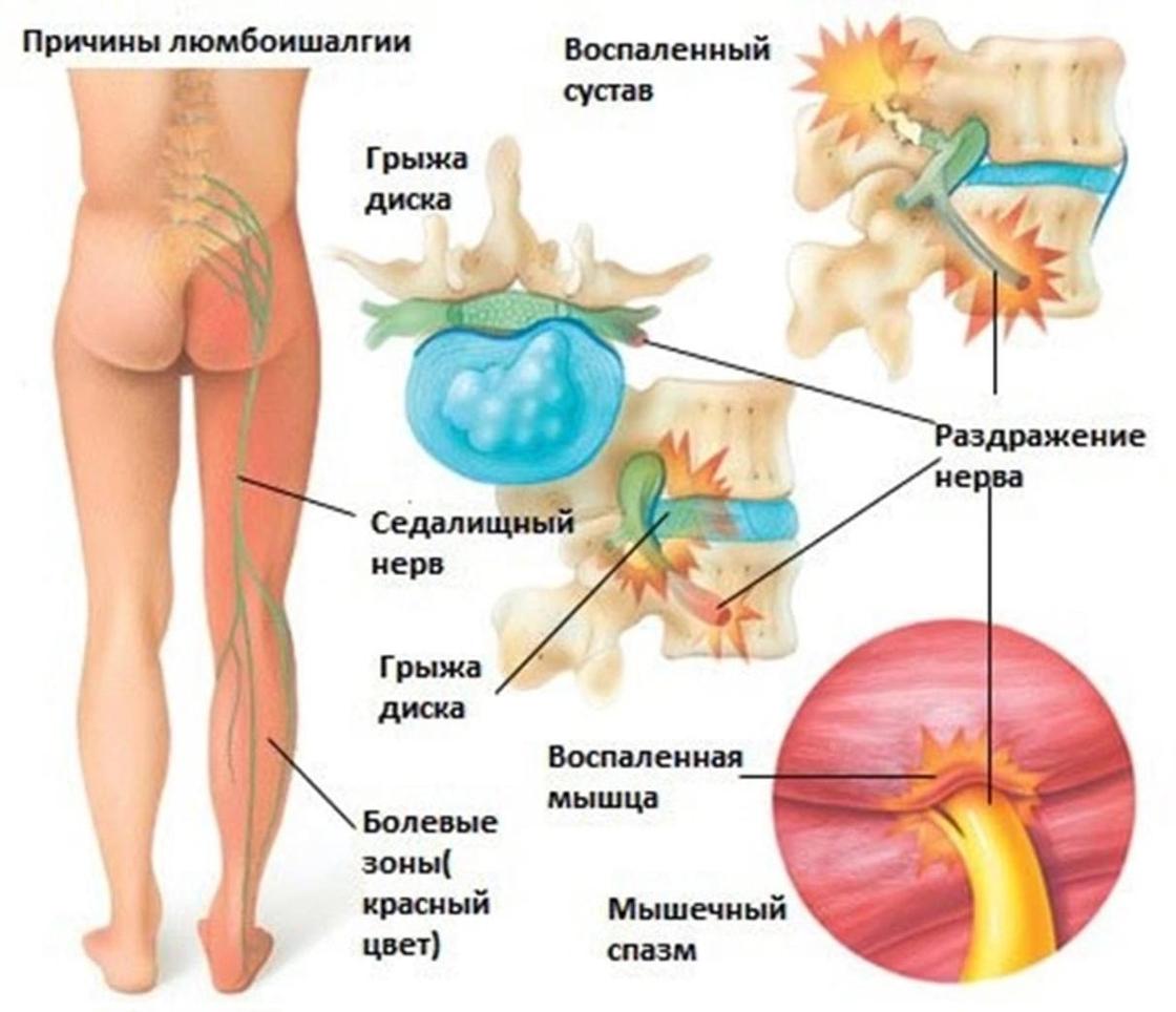 Казахстанцам рассказали, что значит «сорвать спину» и как это лечить