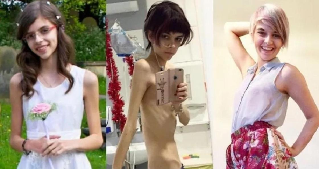 Девушка, которая весила как пятилетний ребенок, победила анорексию и стала звездой инстаграма