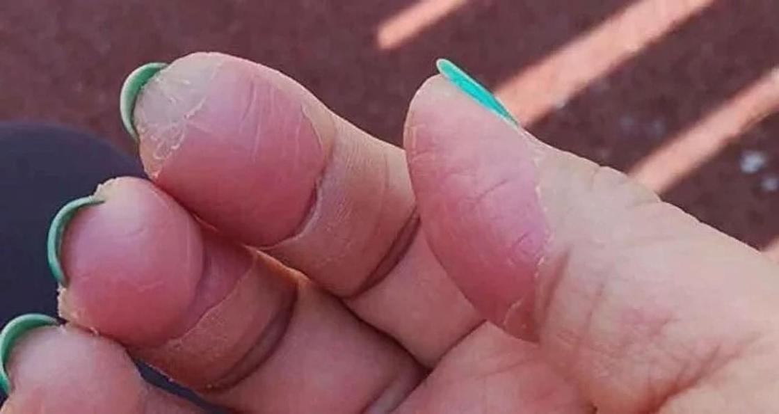 У алматинки слезла кожа с пальцев от жидкости для снятия лака (фото)