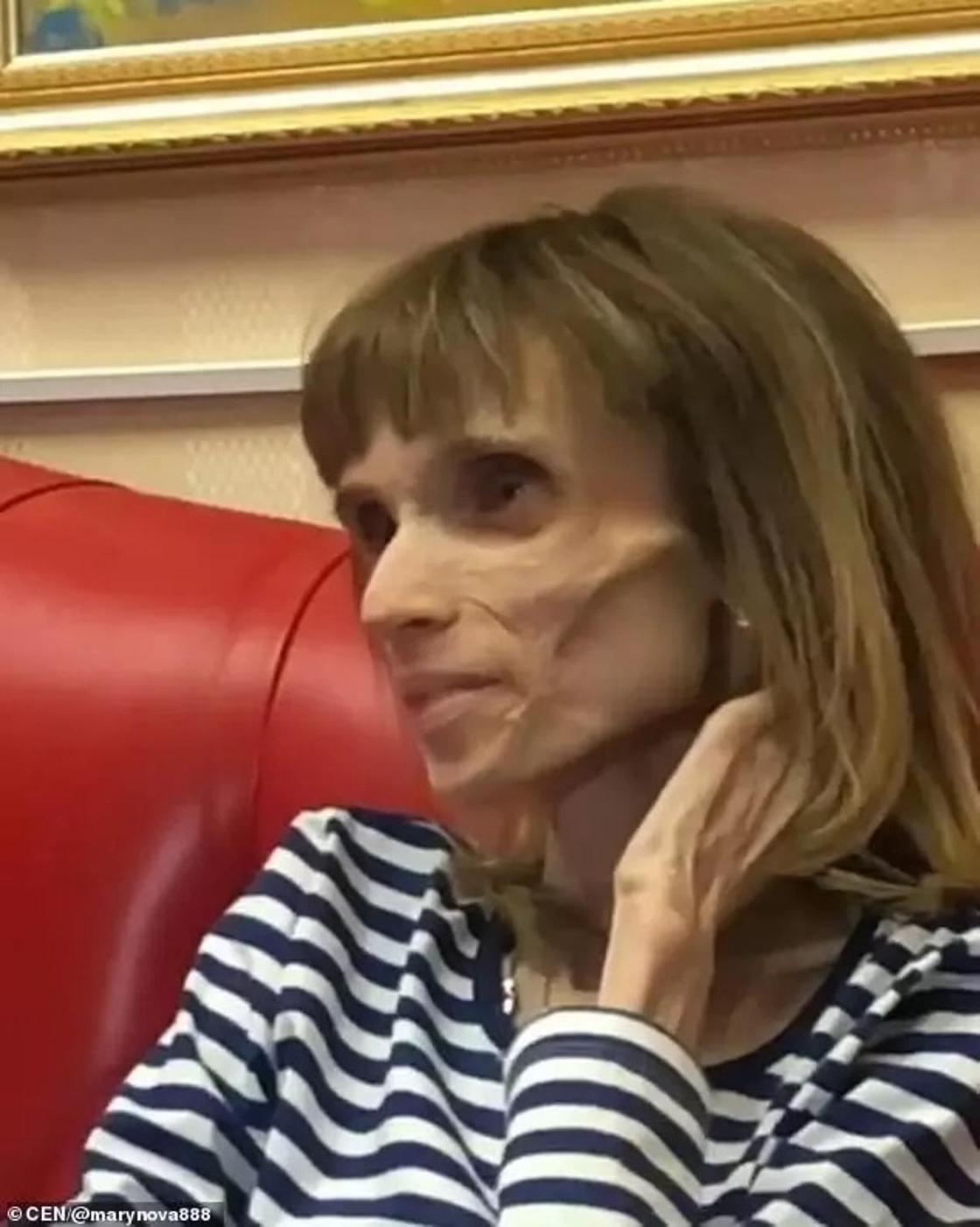 «Ты могла бы сыграть труп в ужастике»: доктор унизил девушку с анорексией «Ты могла бы сыграть труп в ужастике»: доктор унизил девушку с анорексией