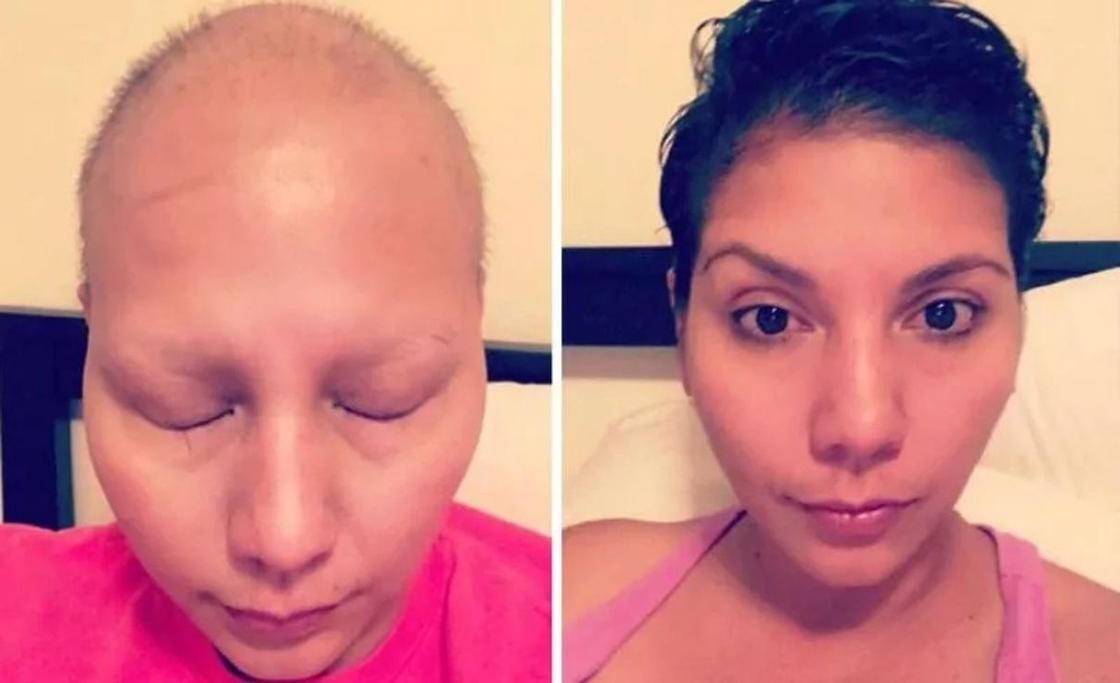 Отзывы вылечившихся людей. Люди до и после химиотерапии. Люди после химиотерапии до и после. Лицо после химиотерапии.