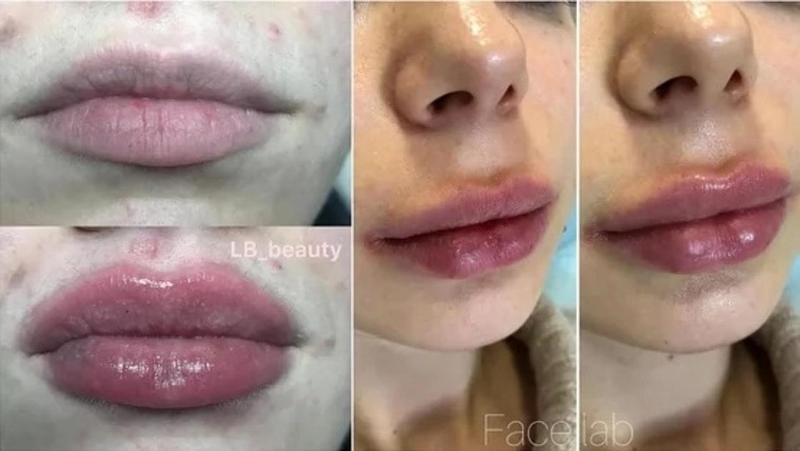 Фото: instagram.com - dr.bilous и lb_beauty_dnepr Фото: instagram.com - dr.bilous и lb_beauty_dnepr