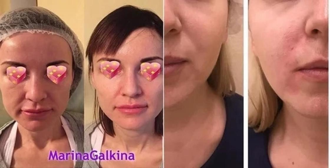 Фото: instagram.com - dr_galkina_cosmetolog и dr.aida_battalova Фото: instagram.com - dr_galkina_cosmetolog и dr.aida_battalova