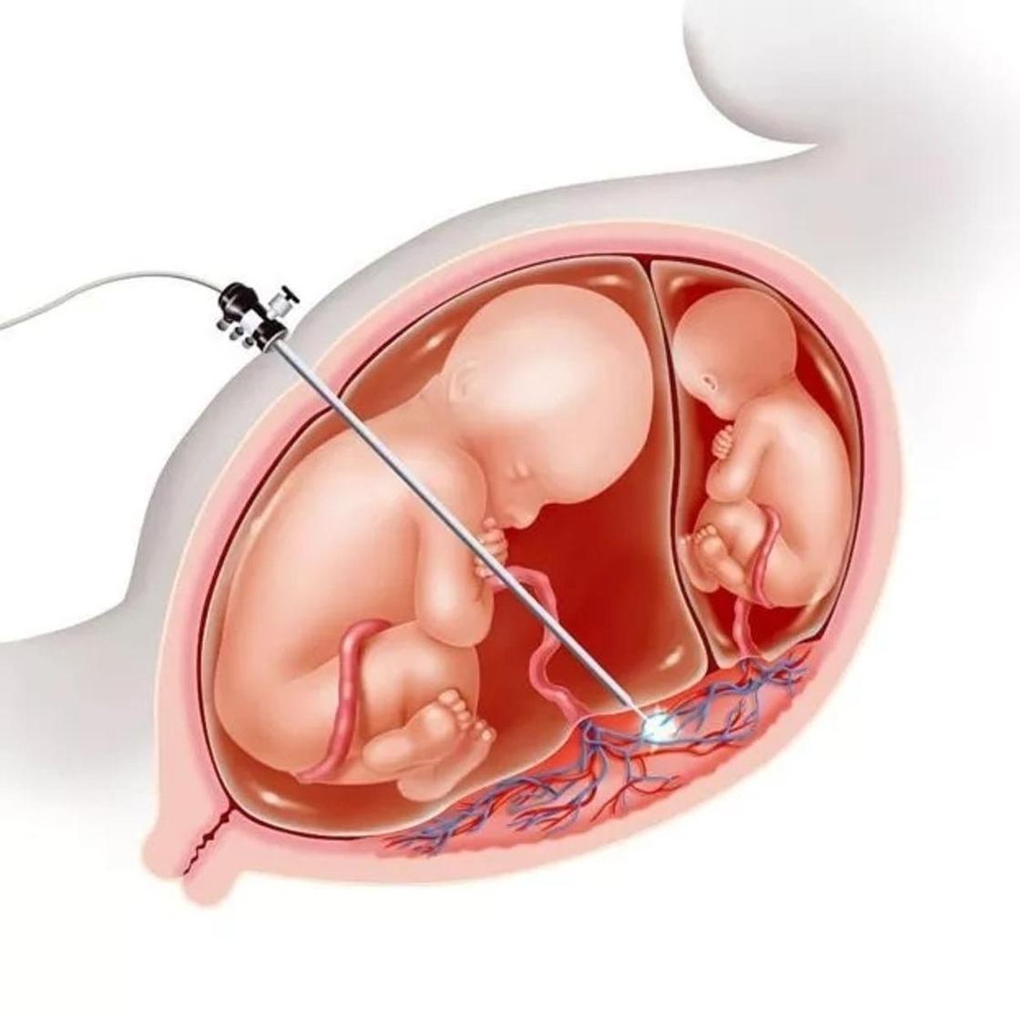 В России сделали операцию эмбриону без кесарева сечения. Как это стало возможным?