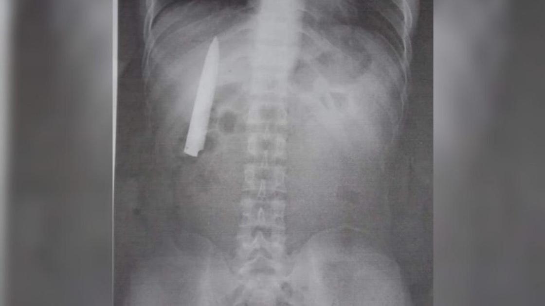 Рентген-снимок филиппинца