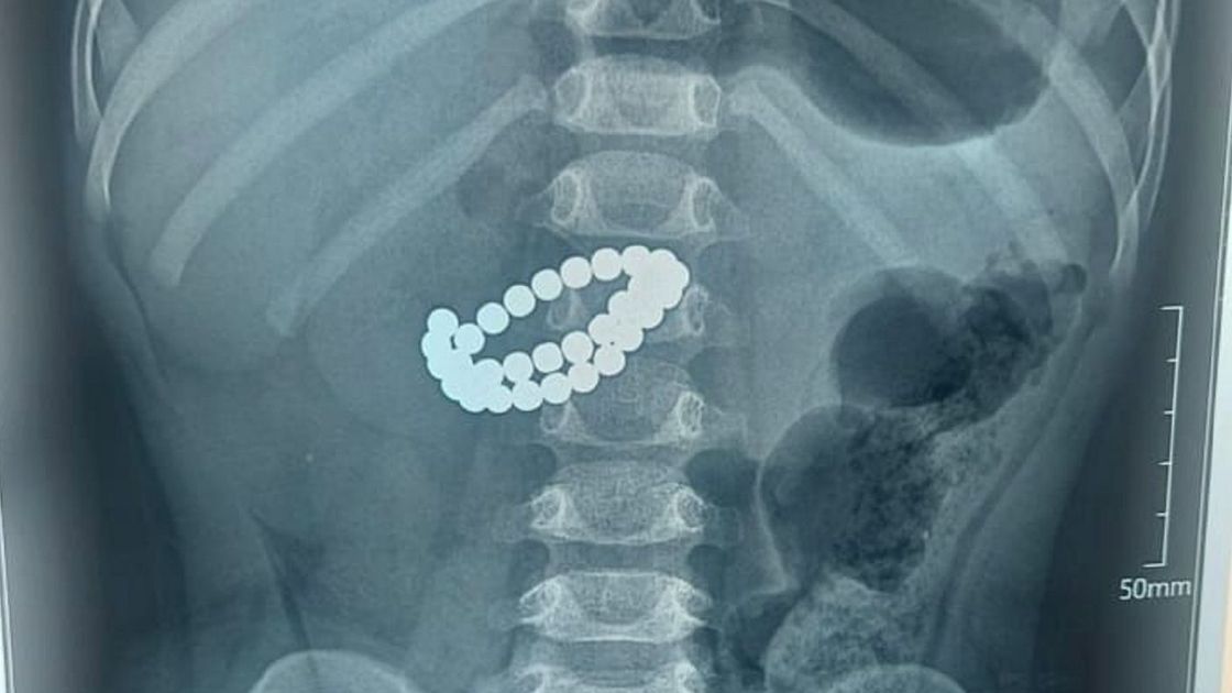Рентген пострадавшего ребенка