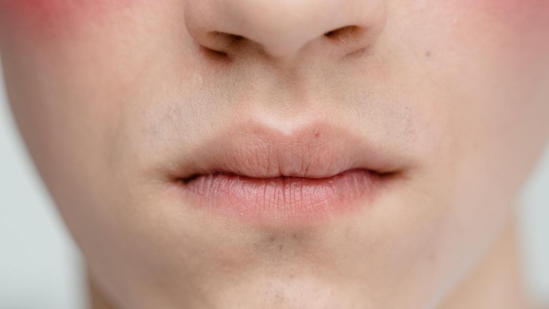Ошибки при увеличении губ гиалуроновой кислотой