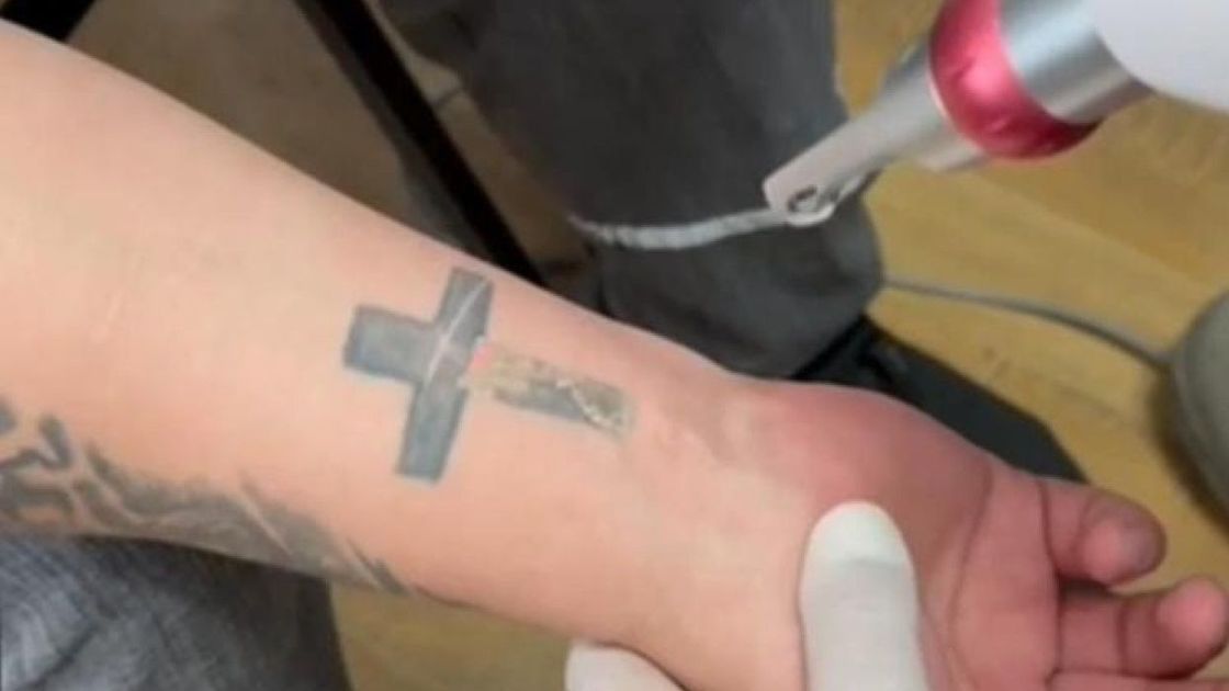 Удаление татуировки