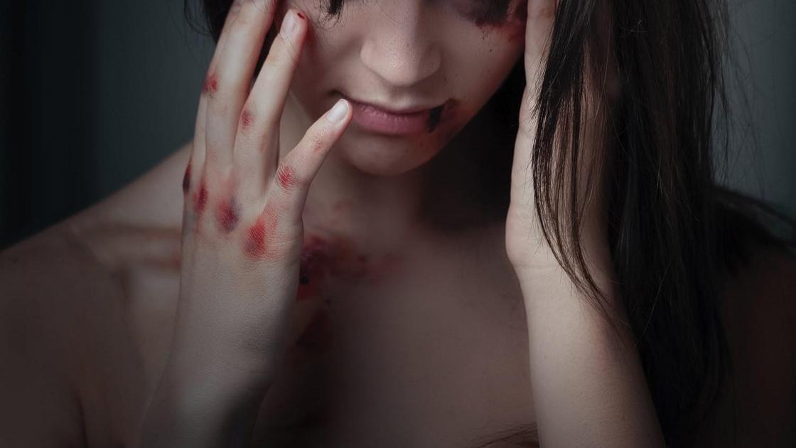 Девушка с кровоподтеками на руках
