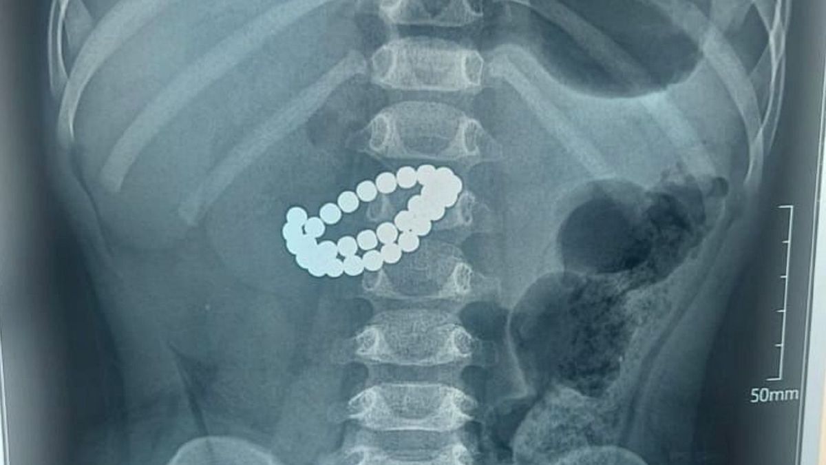 Рентген пострадавшего ребенка
