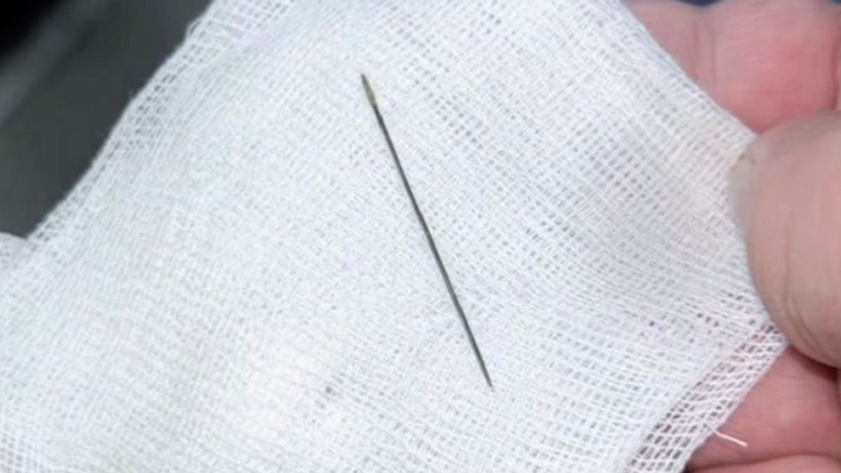 Игла, извлеченная из тела ребенка. Фото