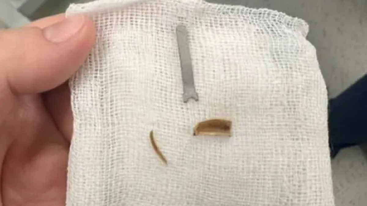 Изъятые из легкого предметы