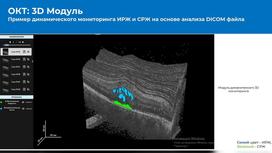 Пример динамического мониторинга ИРЖ и СРЖ на основе анализа DICOM файла