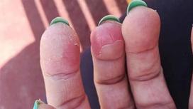 У алматинки слезла кожа с пальцев от жидкости для снятия лака (фото)