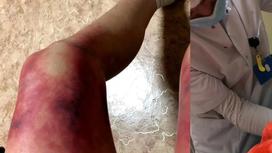 Студентка бежала по Астане в колготках и жутко обморозила ноги (фото)