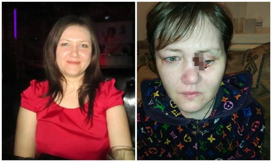 Стало известно о судьбе гниющей заживо от загадочной болезни актюбинки Стало известно о судьбе гниющей заживо от загадочной болезни актюбинки