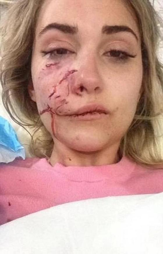 Питбуль изуродовал лицо 23-летней модели Питбуль изуродовал лицо 23-летней модели