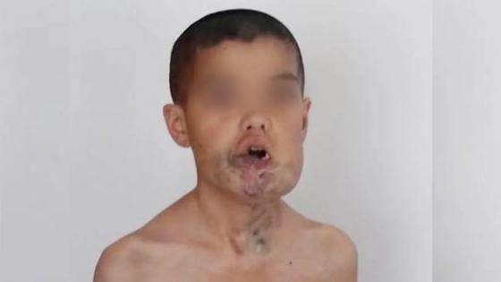 Тілі аузына сыймайтын балақайдың ата-анасы перзентінің дертіне ем таппай, жанұшырып жүр Тілі аузына сыймайтын балақайдың ата-анасы перзентінің дертіне ем таппай, жанұшырып жүр