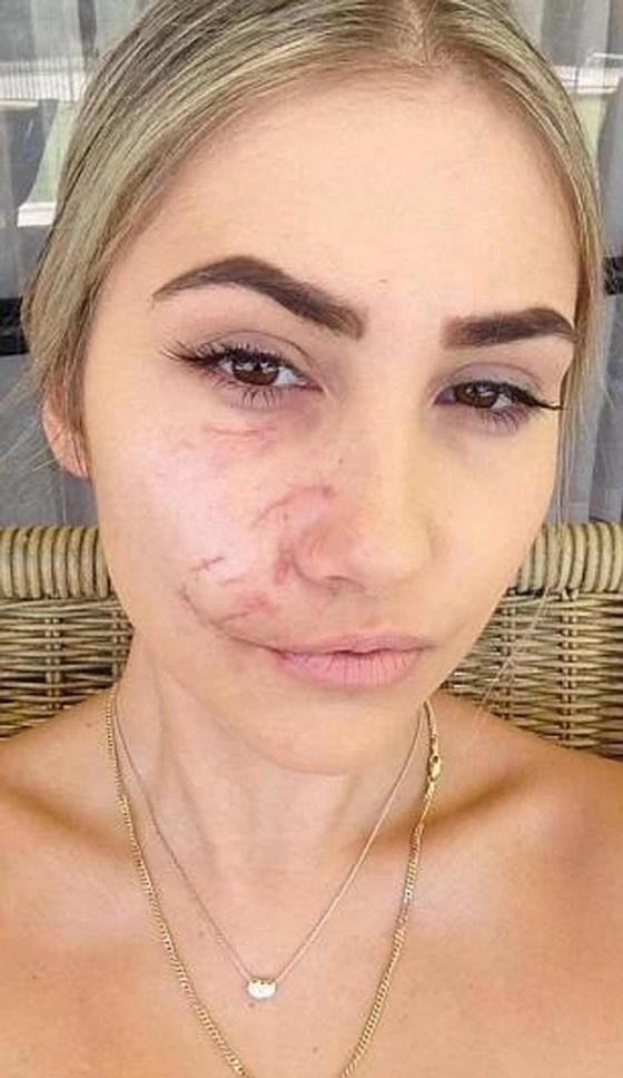 Питбуль изуродовал лицо 23-летней модели Питбуль изуродовал лицо 23-летней модели