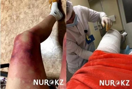 Суықтан үсіген бойжеткеннің аяғы Суықтан үсіген бойжеткеннің аяғы