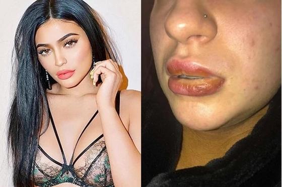 Девушка едва не умерла из-за поддельной помады Kylie Cosmetics Девушка едва не умерла из-за поддельной помады Kylie Cosmetics