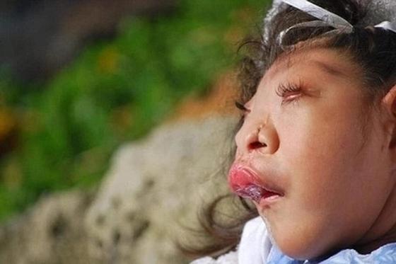 Родившаяся без части мозга девочка умерла в 10 лет Родившаяся без части мозга девочка умерла в 10 лет