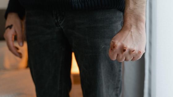 Ссадины на руках у мужчины после ударов Ссадины на руках у мужчины после ударов